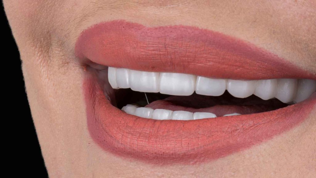 ציפוי חרסינה לשיניים חסרות