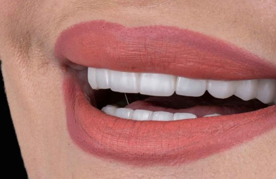 ציפוי חרסינה לשיניים חסרות2